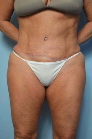 Liposuction Before & After Gallery - Patient 360731 - Image 2