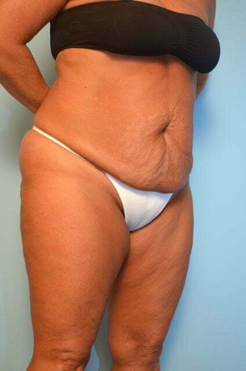 Liposuction Before & After Gallery - Patient 360731 - Image 3