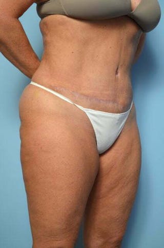 Liposuction Before & After Gallery - Patient 360731 - Image 4