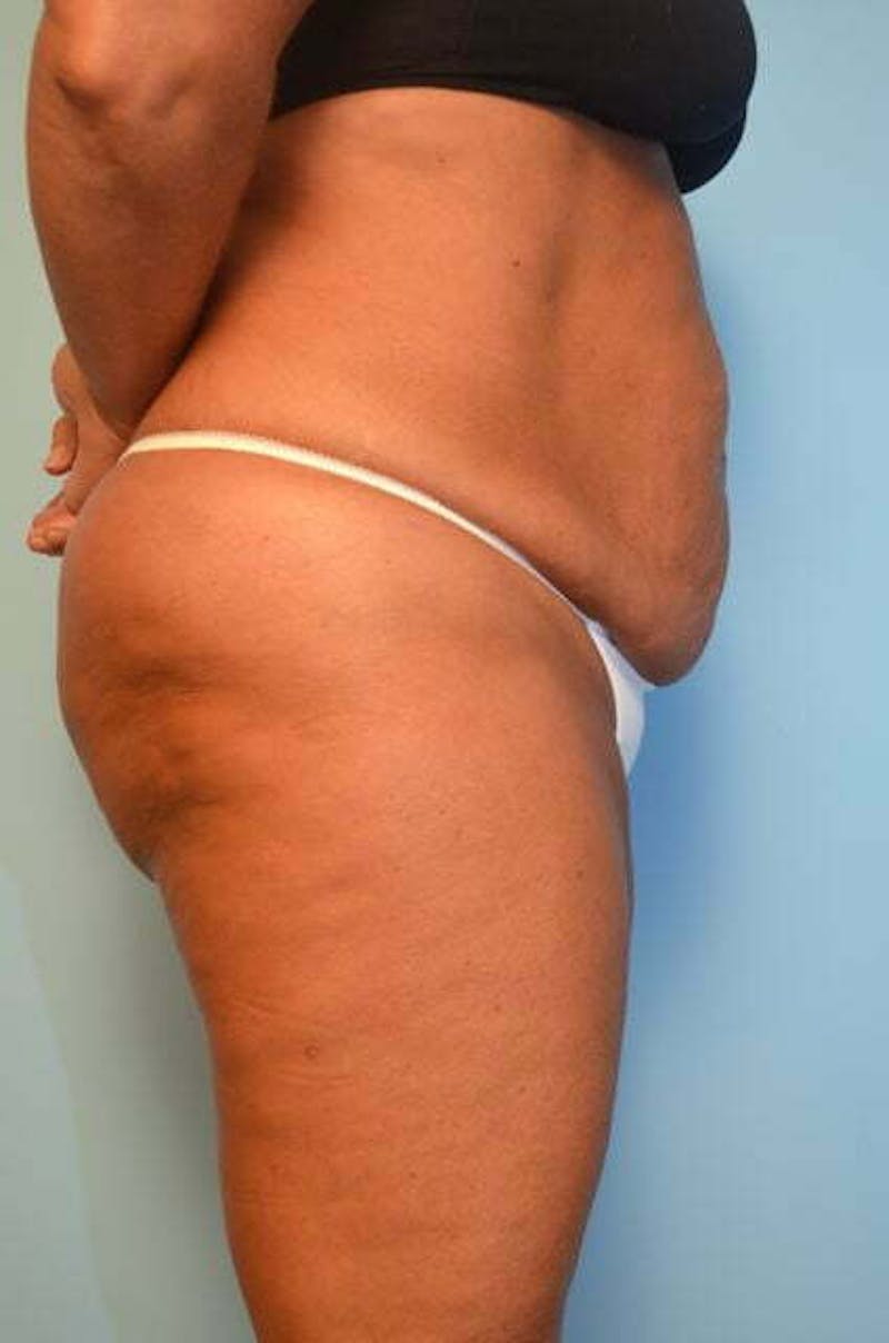 Liposuction Before & After Gallery - Patient 360731 - Image 5