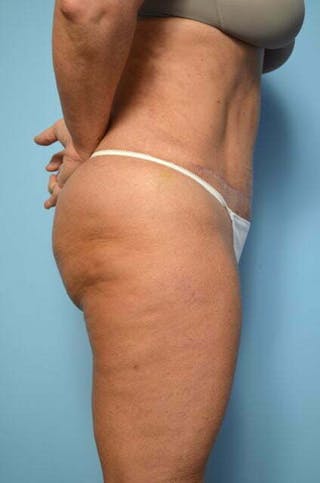 Liposuction Before & After Gallery - Patient 360731 - Image 6