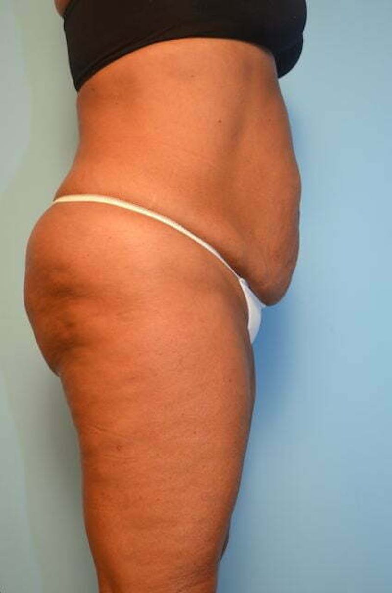 Liposuction Before & After Gallery - Patient 360731 - Image 7