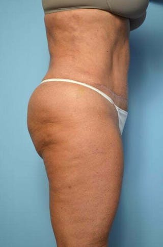 Liposuction Before & After Gallery - Patient 360731 - Image 8