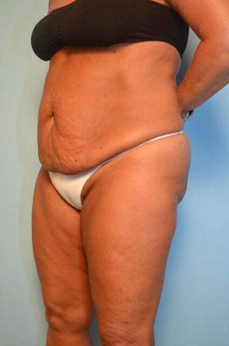 Liposuction Before & After Gallery - Patient 360731 - Image 9