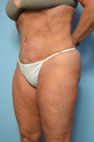 Liposuction Before & After Gallery - Patient 360731 - Image 10