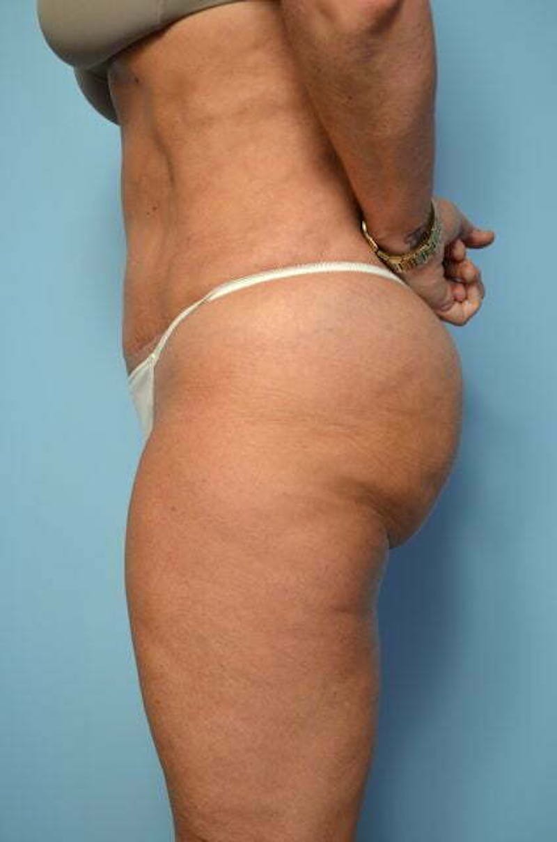 Liposuction Before & After Gallery - Patient 360731 - Image 12