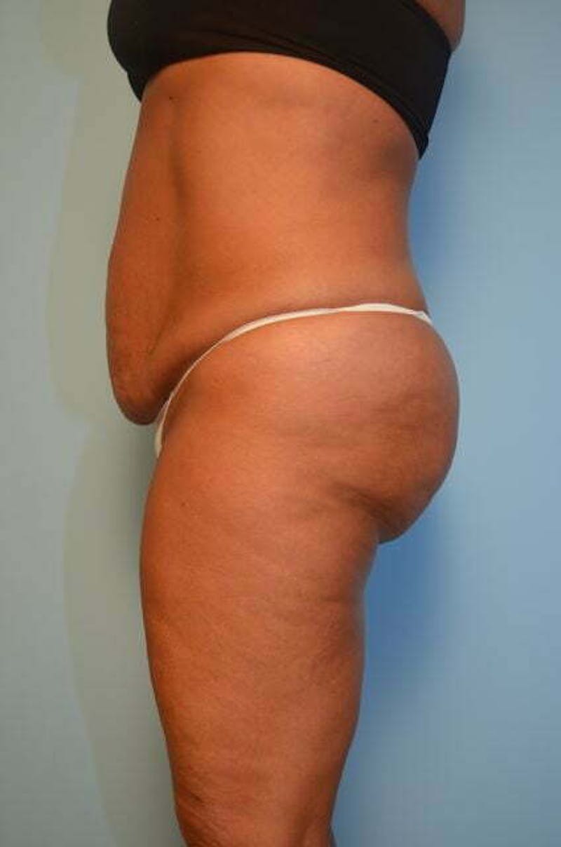Liposuction Before & After Gallery - Patient 360731 - Image 13