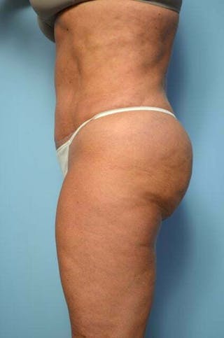 Liposuction Before & After Gallery - Patient 360731 - Image 14