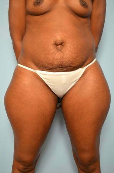 Tummy Tuck Before & After Gallery - Patient 282262 - Image 1