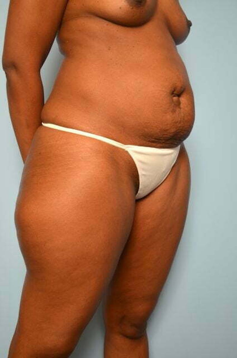 Tummy Tuck Before & After Gallery - Patient 282262 - Image 3