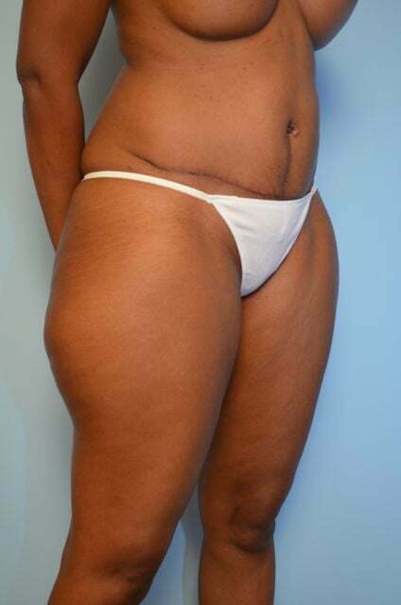 Tummy Tuck Before & After Gallery - Patient 282262 - Image 4
