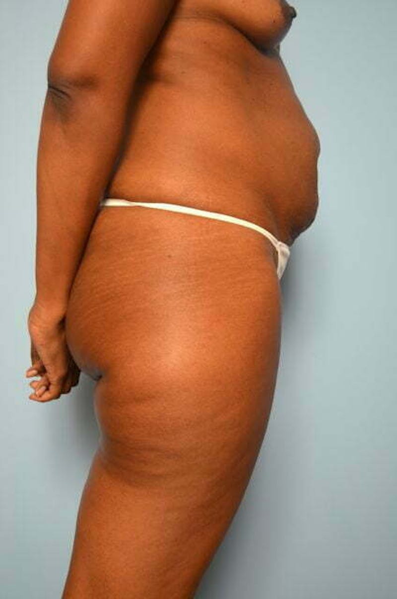 Tummy Tuck Before & After Gallery - Patient 282262 - Image 5