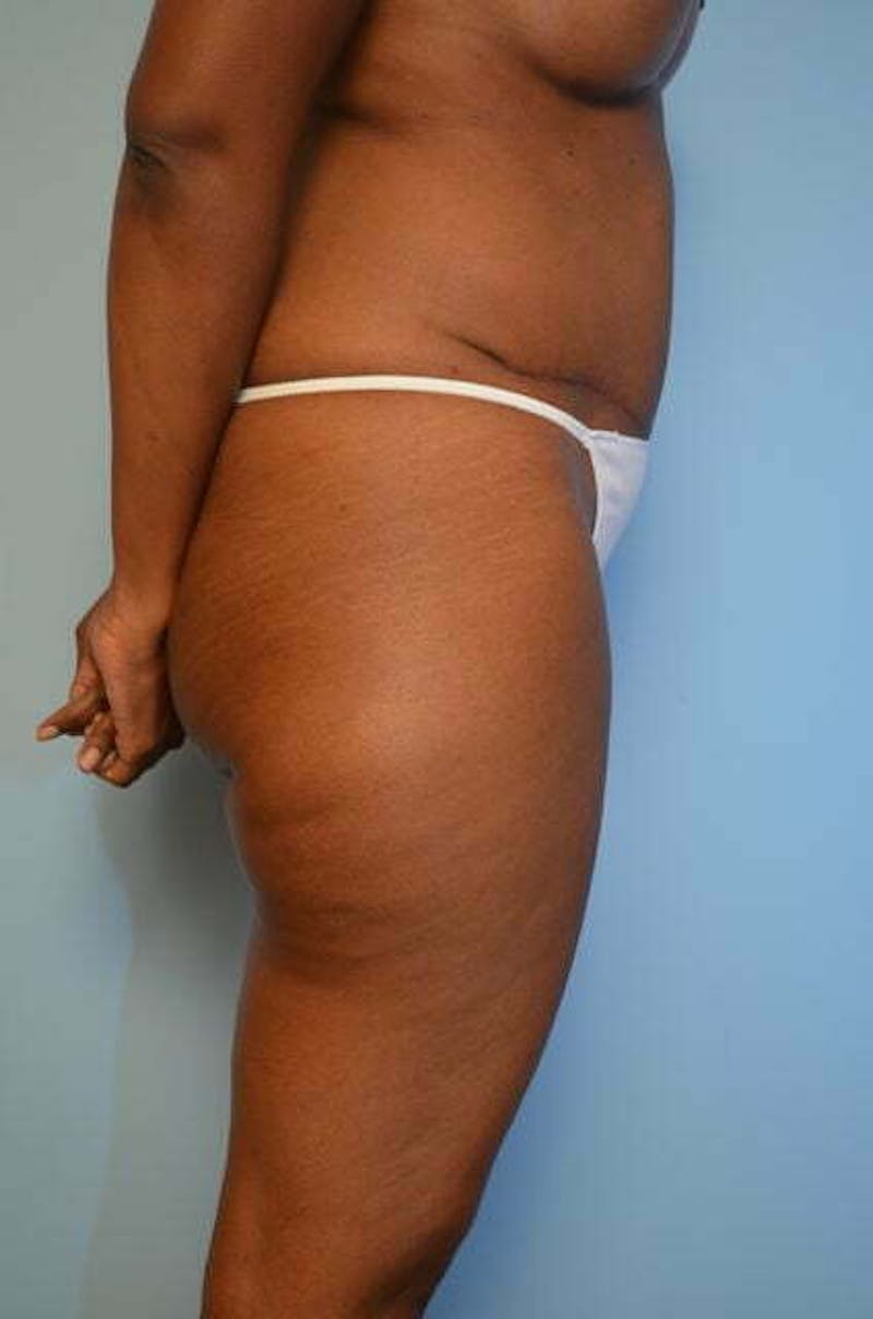 Tummy Tuck Before & After Gallery - Patient 282262 - Image 6