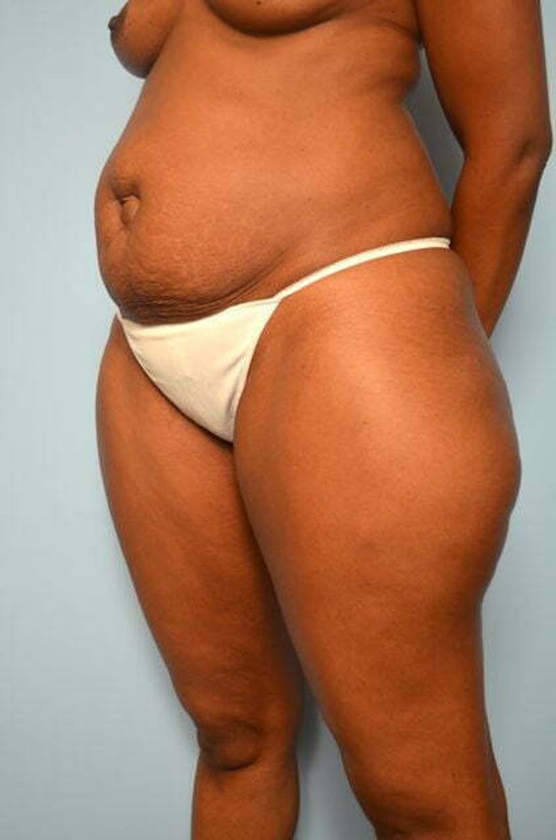 Tummy Tuck Before & After Gallery - Patient 282262 - Image 7