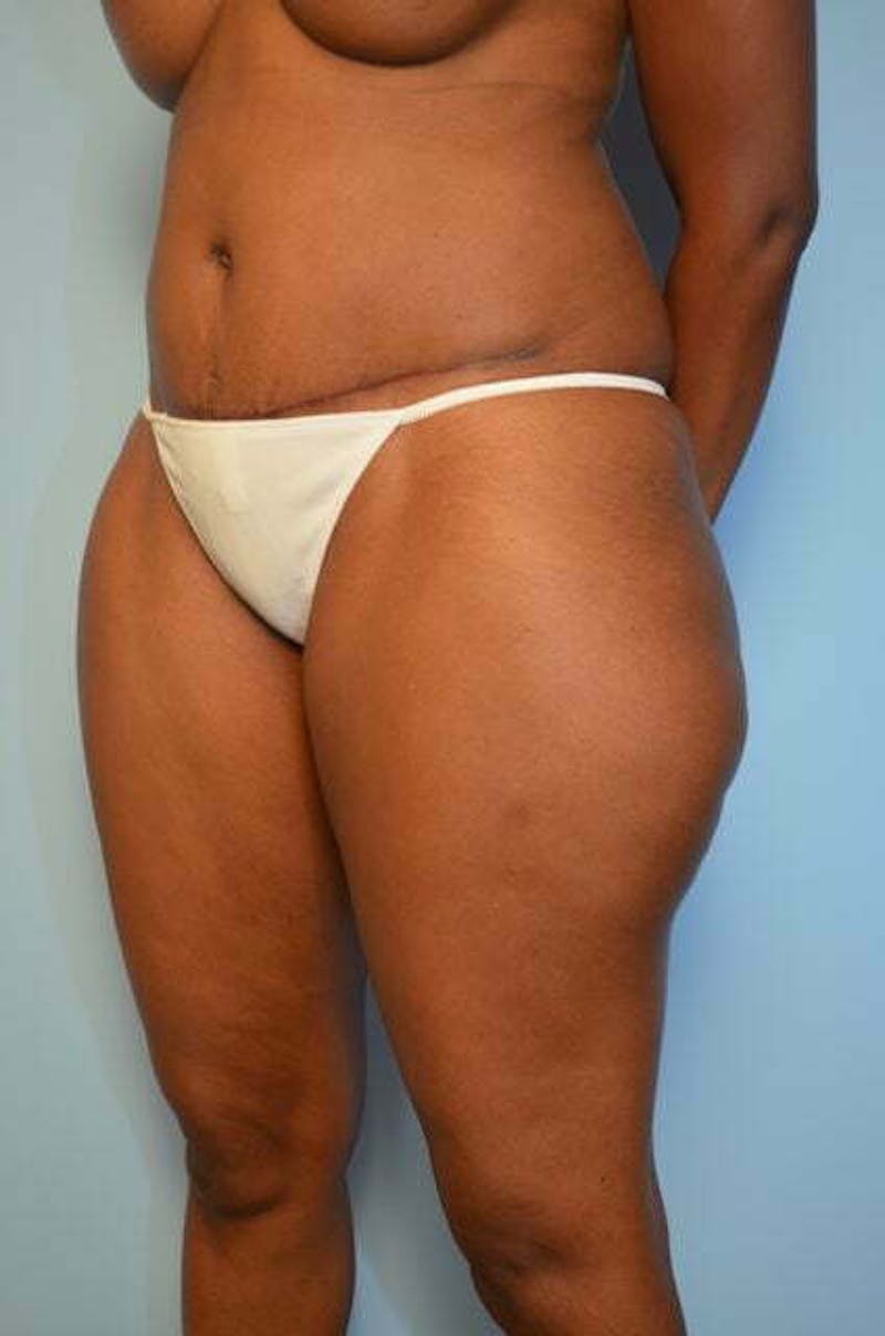 Tummy Tuck Before & After Gallery - Patient 282262 - Image 8