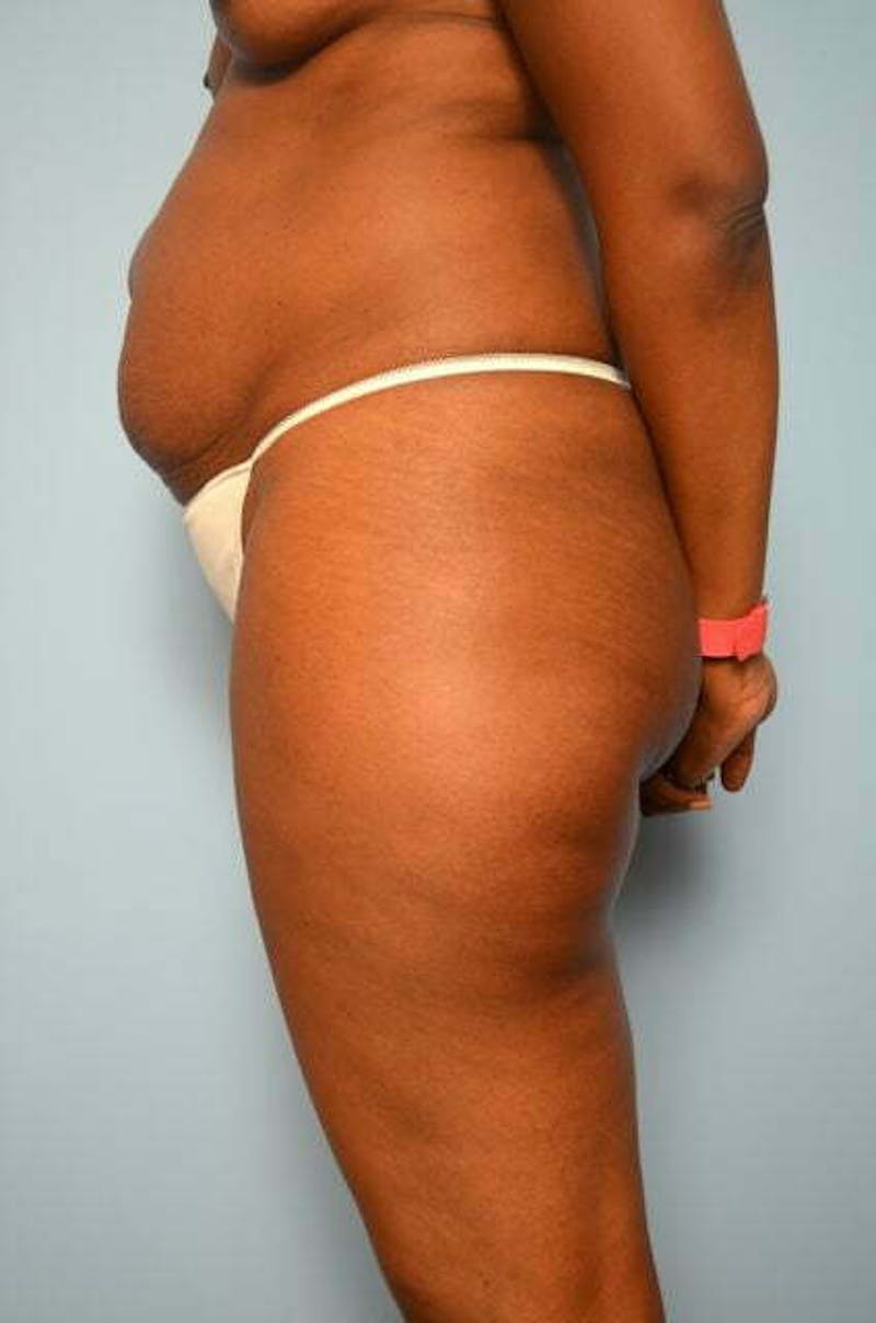 Tummy Tuck Before & After Gallery - Patient 282262 - Image 9