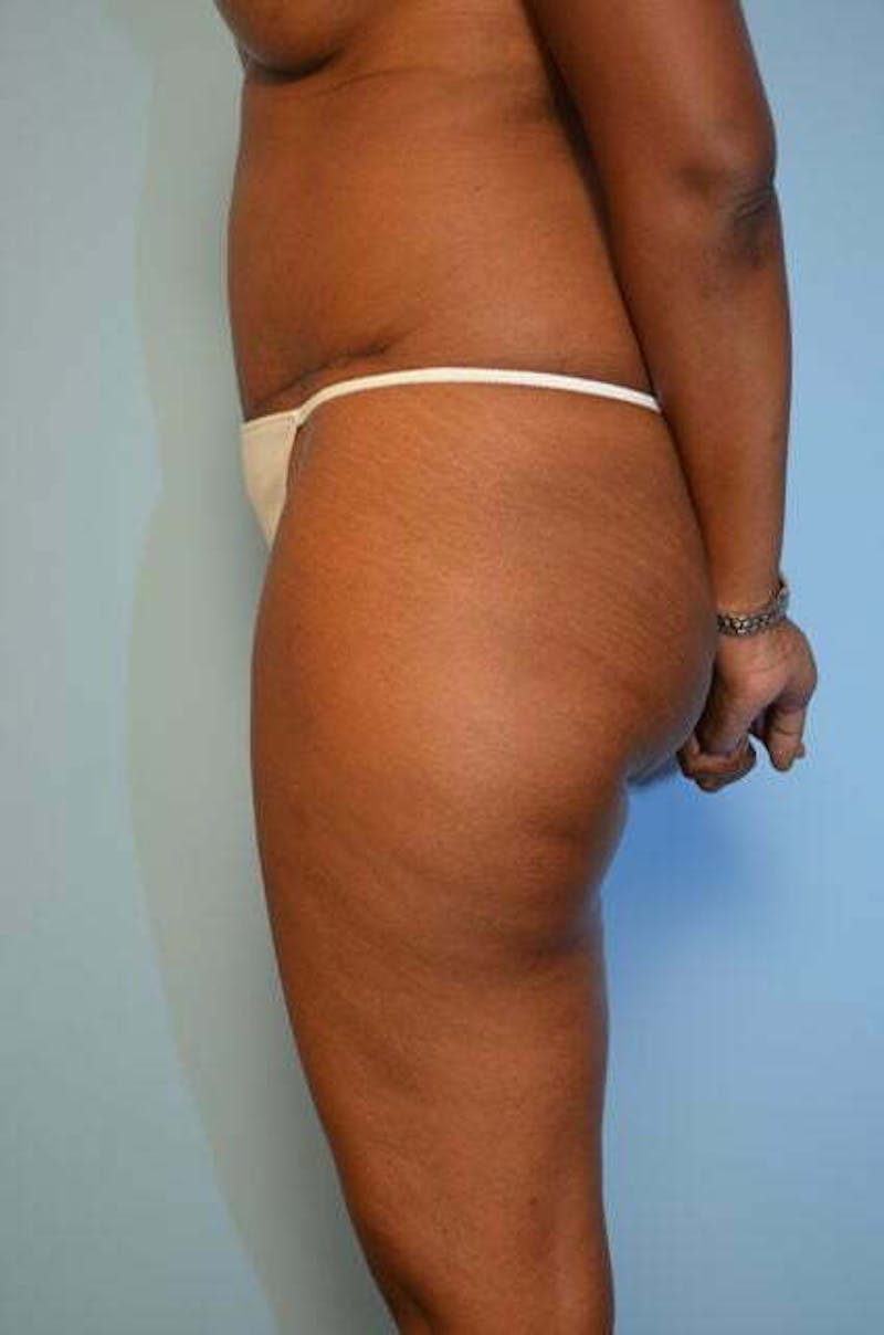 Tummy Tuck Before & After Gallery - Patient 282262 - Image 10