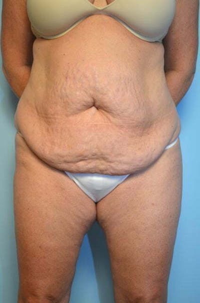 Liposuction Before & After Gallery - Patient 305983 - Image 1