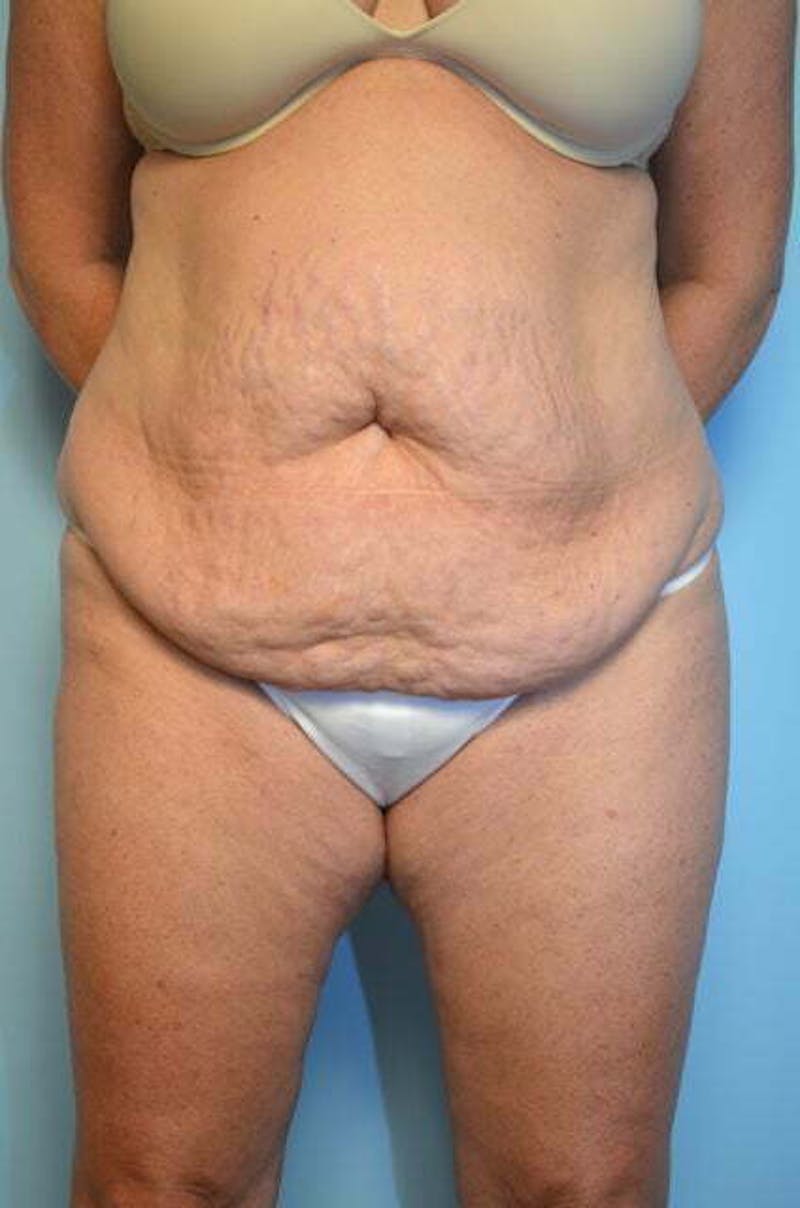 Liposuction Before & After Gallery - Patient 305983 - Image 1