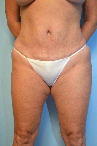 Liposuction Before & After Gallery - Patient 305983 - Image 2