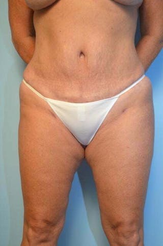 Liposuction Before & After Gallery - Patient 305983 - Image 2