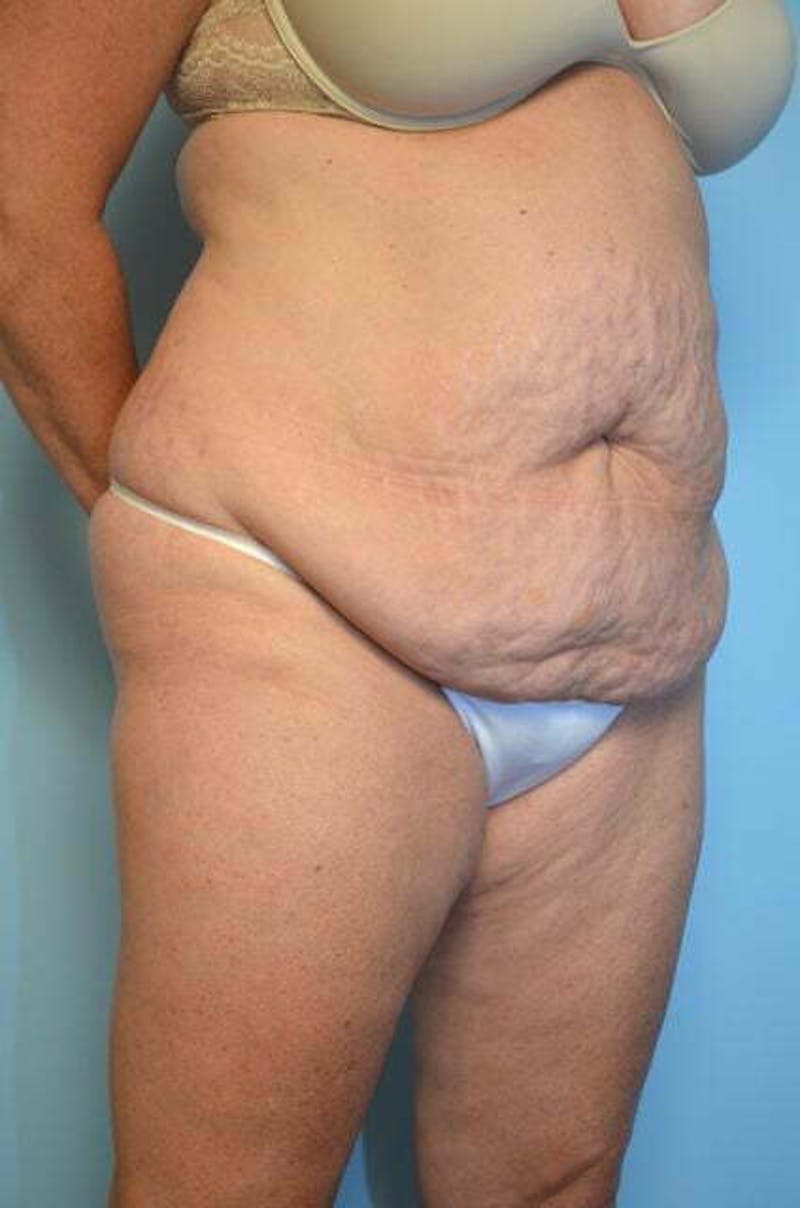 Liposuction Before & After Gallery - Patient 305983 - Image 3