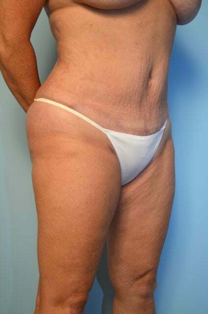 Liposuction Before & After Gallery - Patient 305983 - Image 4