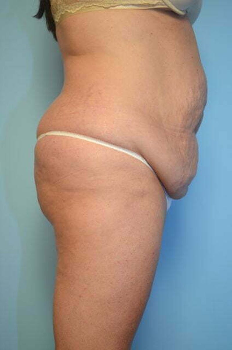 Liposuction Before & After Gallery - Patient 305983 - Image 5
