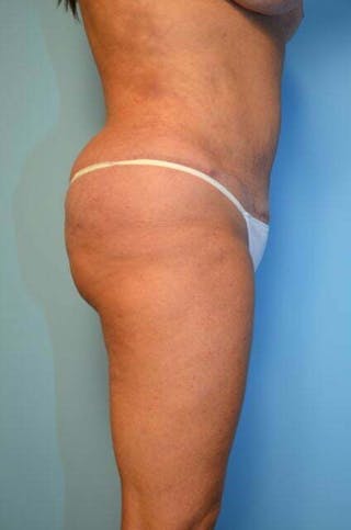 Liposuction Before & After Gallery - Patient 305983 - Image 6