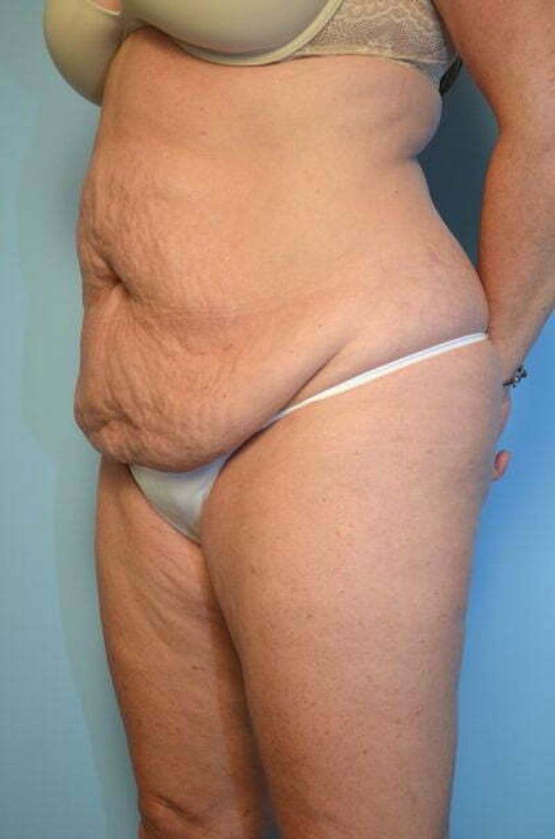 Liposuction Before & After Gallery - Patient 305983 - Image 7