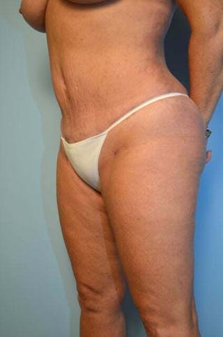 Liposuction Before & After Gallery - Patient 305983 - Image 8