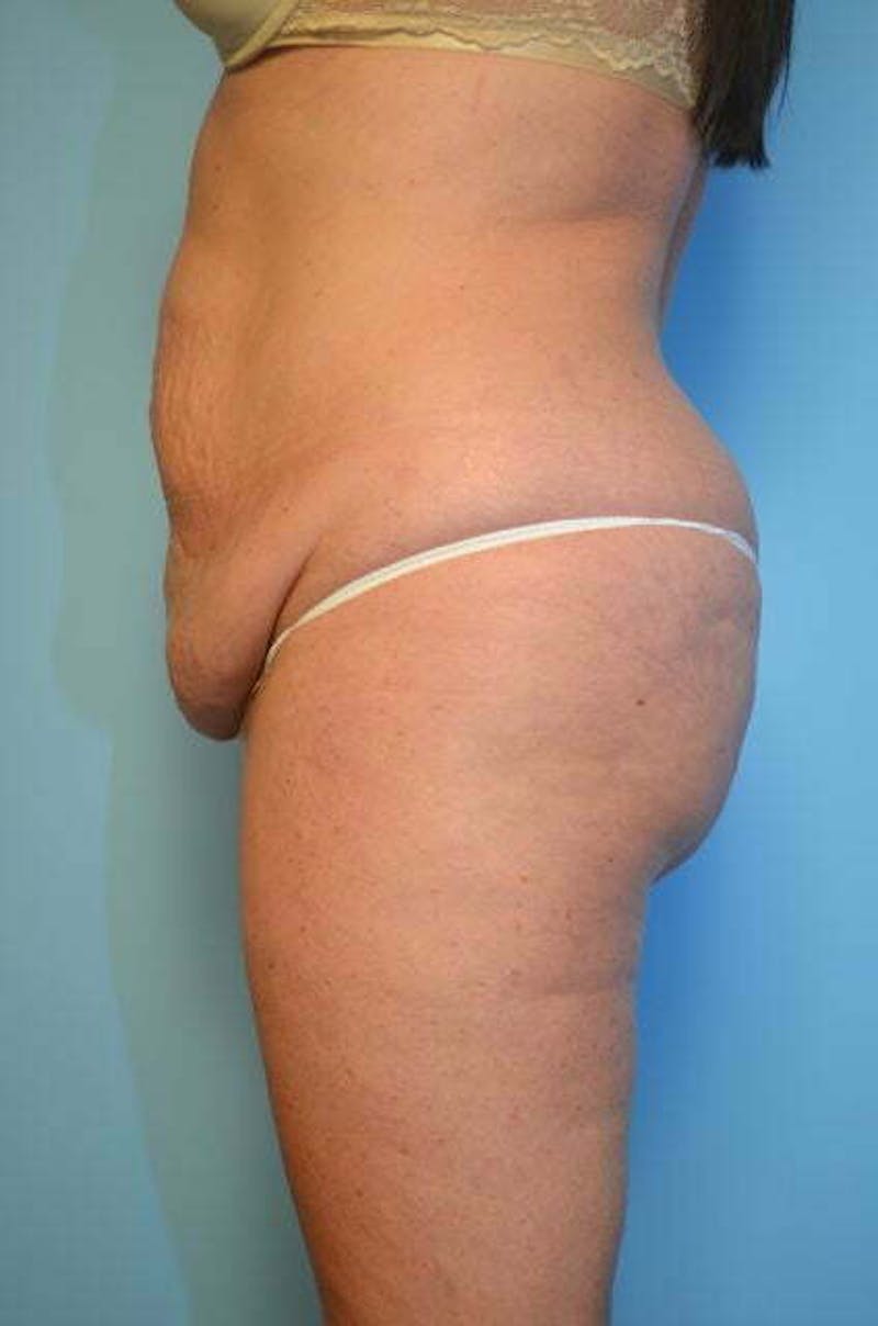 Liposuction Before & After Gallery - Patient 305983 - Image 9