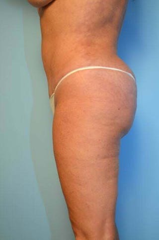 Liposuction Before & After Gallery - Patient 305983 - Image 10
