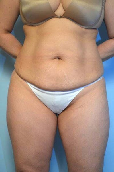 Liposuction Before & After Gallery - Patient 272436 - Image 1