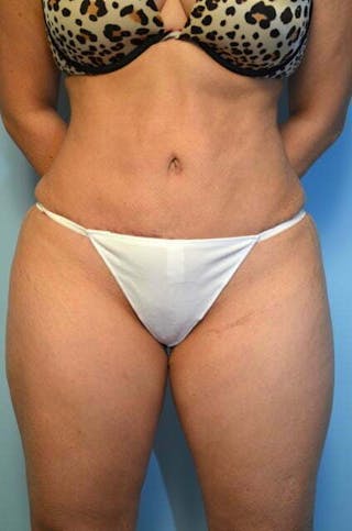 Tummy Tuck Before & After Gallery - Patient 364328 - Image 2