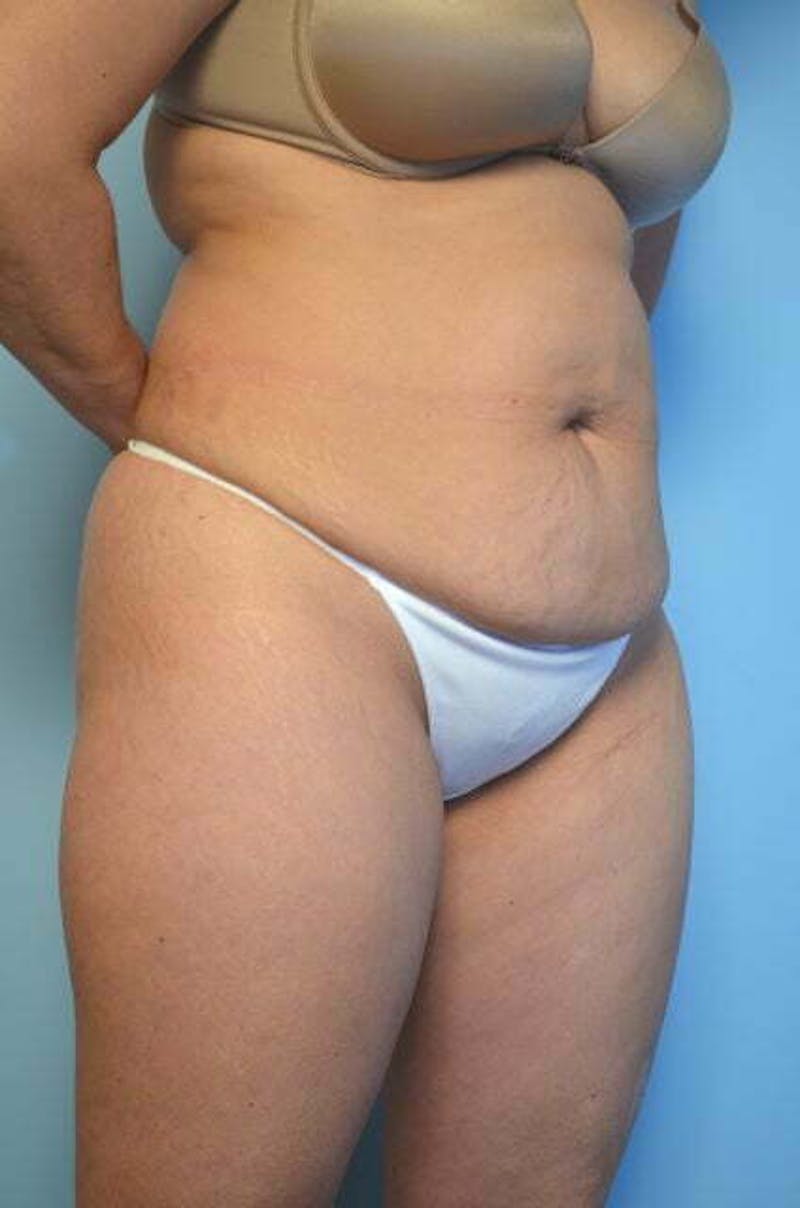 Tummy Tuck Before & After Gallery - Patient 364328 - Image 3