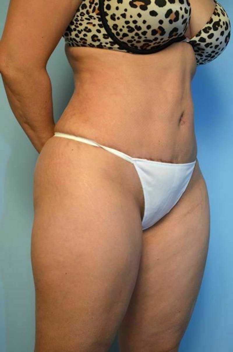 Tummy Tuck Before & After Gallery - Patient 364328 - Image 4