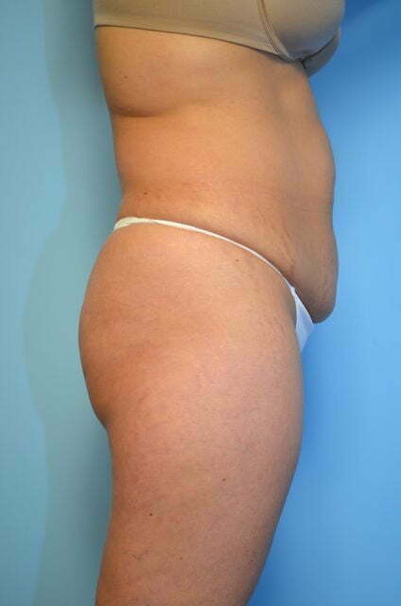 Tummy Tuck Before & After Gallery - Patient 364328 - Image 5