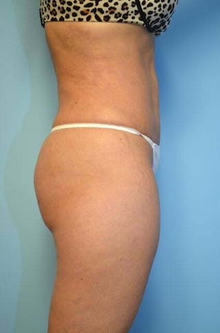Tummy Tuck Before & After Gallery - Patient 364328 - Image 6
