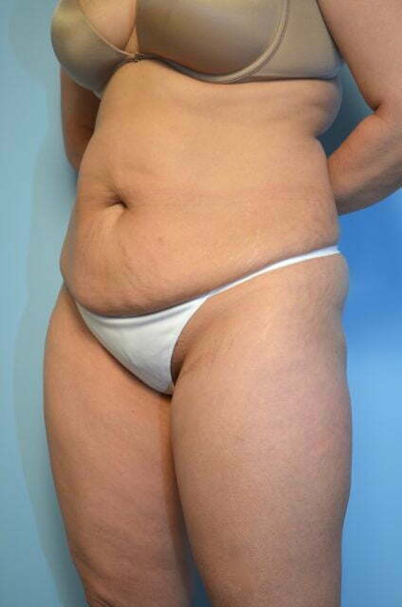 Tummy Tuck Before & After Gallery - Patient 364328 - Image 7
