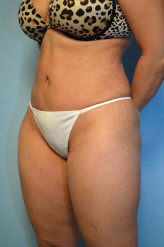 Tummy Tuck Before & After Gallery - Patient 364328 - Image 8