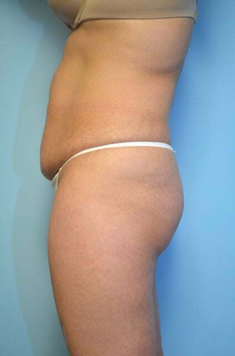 Tummy Tuck Before & After Gallery - Patient 364328 - Image 9