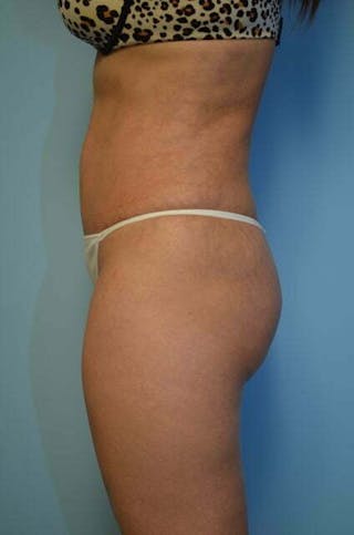 Tummy Tuck Before & After Gallery - Patient 364328 - Image 10