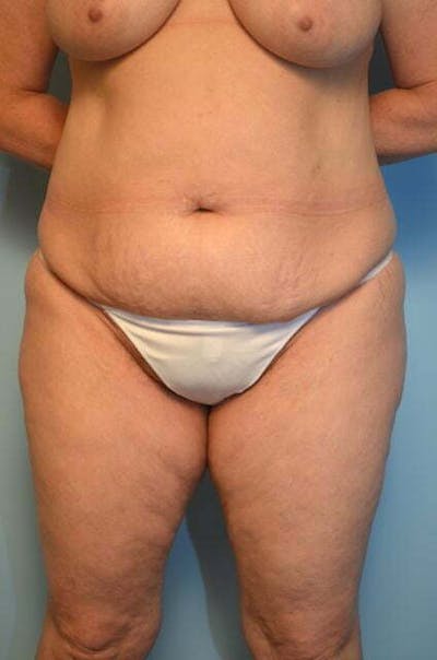 Liposuction Before & After Gallery - Patient 341886 - Image 1