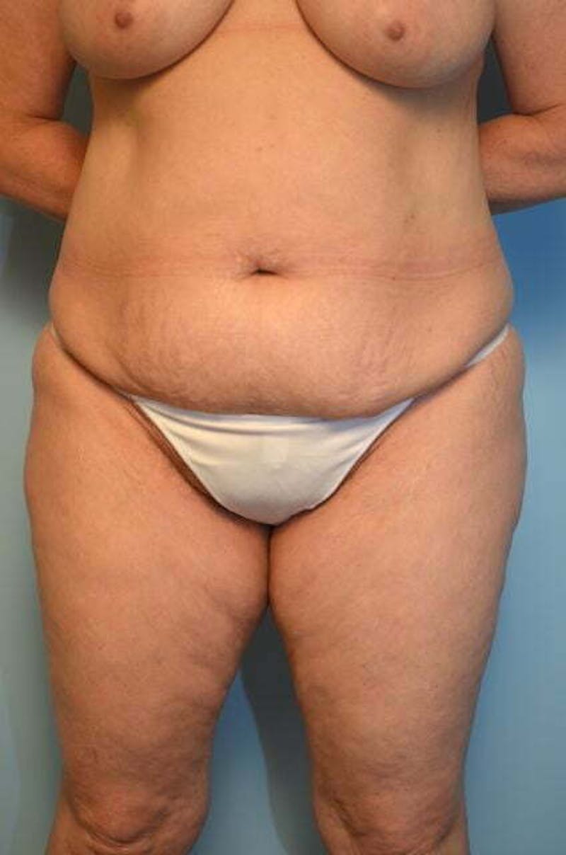 Liposuction Before & After Gallery - Patient 341886 - Image 1