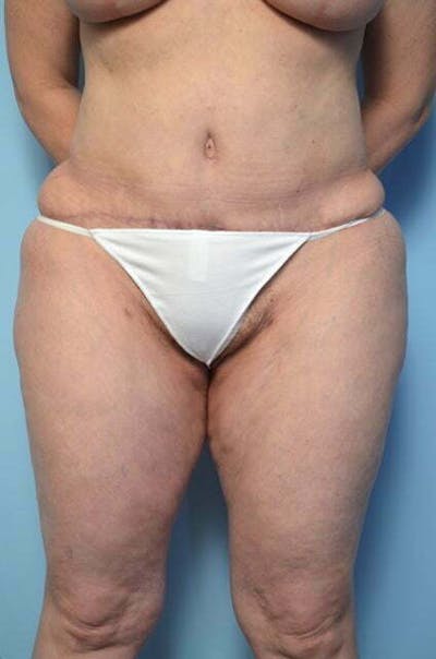 Liposuction Before & After Gallery - Patient 341886 - Image 2