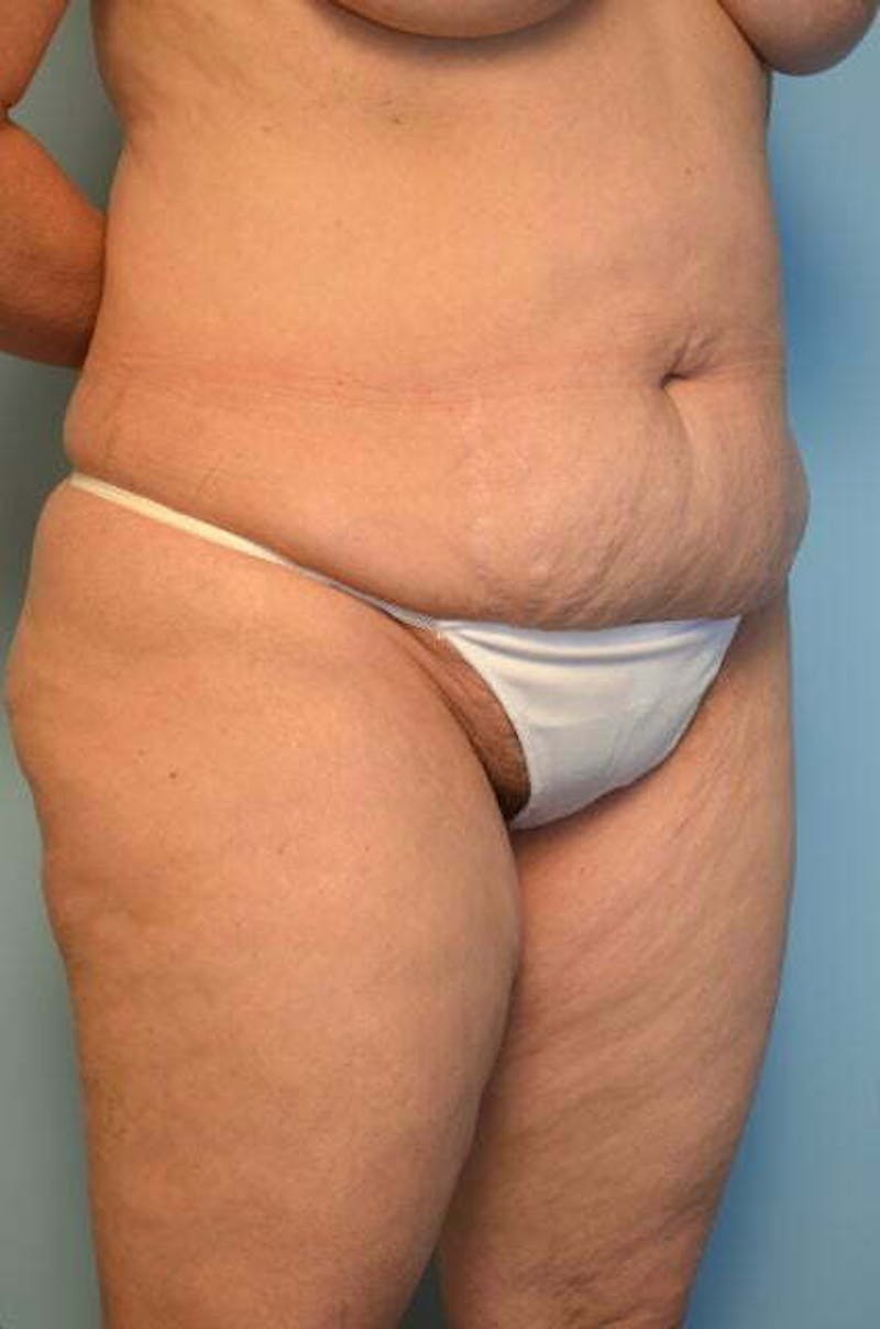 Liposuction Before & After Gallery - Patient 341886 - Image 3