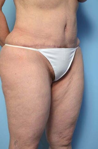 Liposuction Before & After Gallery - Patient 341886 - Image 4