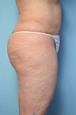 Liposuction Before & After Gallery - Patient 341886 - Image 6