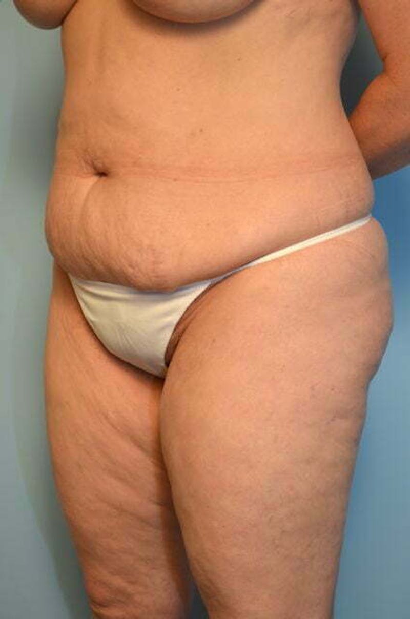 Liposuction Before & After Gallery - Patient 341886 - Image 7